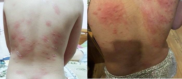 Tình trạng nổi mẩn ngứa sau khi tắm biển khiến người dân bất an