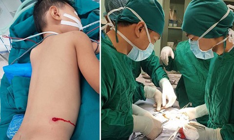 Các bác sĩ tiến hành phẫu thuật lấy viên bi cho bệnh nhi - Ảnh: Công an TP.HCM