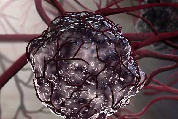 Bác sĩ khuyến cáo giải pháp ngăn ngừa nguy cơ khối u biến đổi ác tính