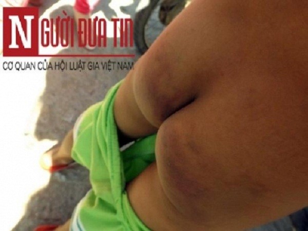 Cô giáo dùng thước gỗ đánh học sinh bị tạm đình chỉ dạy học