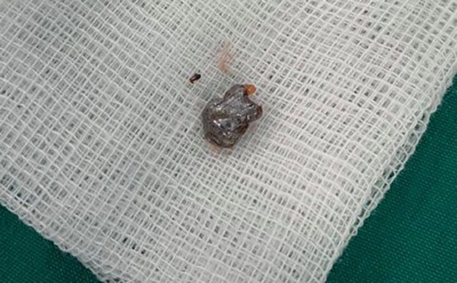 Viên đạn được gắp ra khỏi cơ thể bé trai. Ảnh bệnh viện cung cấp.