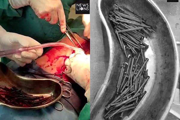 Chuyện khó tin: người đàn ông nuốt 116 chiếc đinh nhọn vào bụng