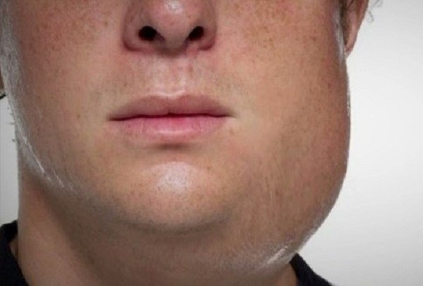 Bệnh quai bị - Hình minh họa: Internet