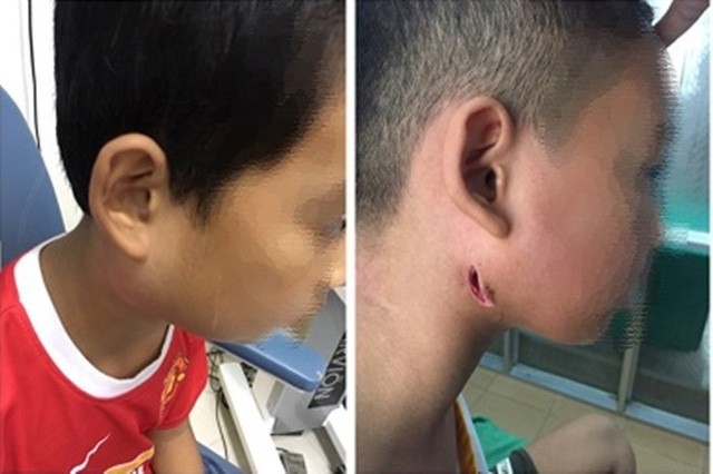 Phát hiện thêm nhiều bệnh nhân mắc vi khuẩn 'ăn thịt người'​