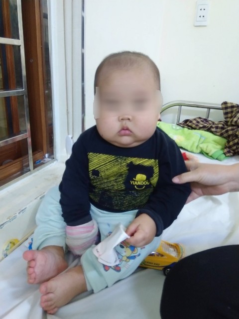 Bệnh nhi bị hội chứng cushing - suy tuyến thượng thận khiến mặt phù nề, tròn to như trái bí đỏ do sử dụng phải loại thuốc có chứa corticoid.