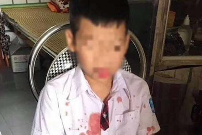 Cháu Kh. bị thương ở vùng mặt và tay sau khi bị Đức hành hung.