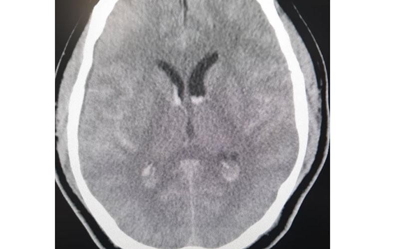 Hình ảnh phim chụp xuất huyết dưới nhện lan tỏa - tụ máu não thất. (Ảnh: Nhân Dân)