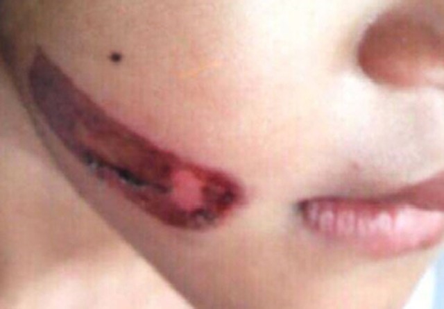 Vết bỏng trên mặt bé T.