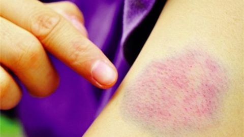 Vết bầm trên da: Dấu hiệu cảnh báo bệnh về máu nguy hiểm