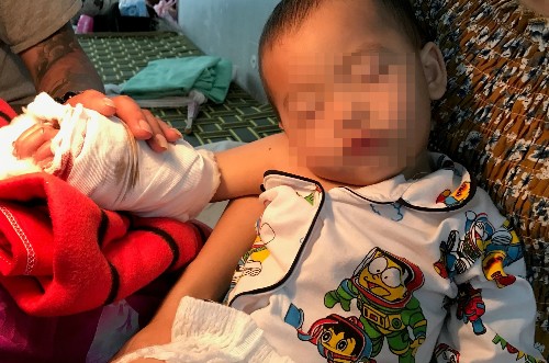 Sau ca mổ nối bàn tay, bé hiện được theo dõi tại bệnh viện.