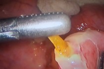 Ăn canh chua cá tai tượng bị xương đâm thủng ruột