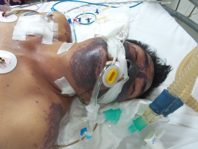 Bệnh do liên cầu lợn gây ra những triệu chứng nặng nề, đe dọa tính mạng người bệnh.