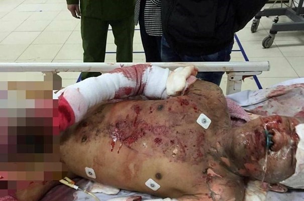 Nạn nhân hiện đã được chuyển lên Hà Nội điều trị. Ảnh: Báo Nghệ An