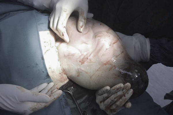 Túi ối vẫn còn nguyên vẹn khi được lấy ra từ bụng thai phụ. Ảnh: BVCC