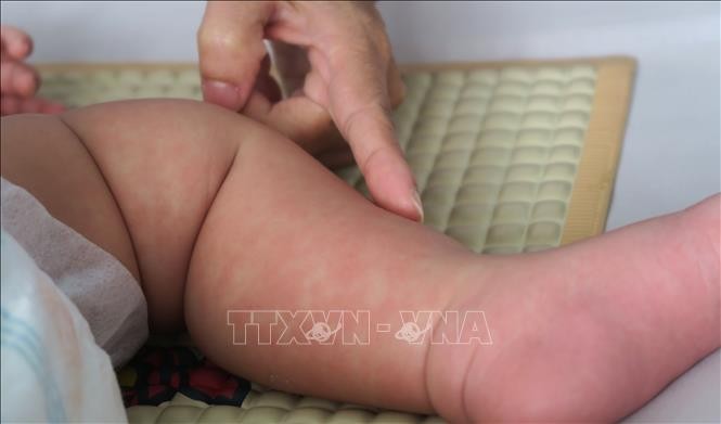 Năm khuyến cáo của Bộ Y tế để phòng, chống bệnh sởi