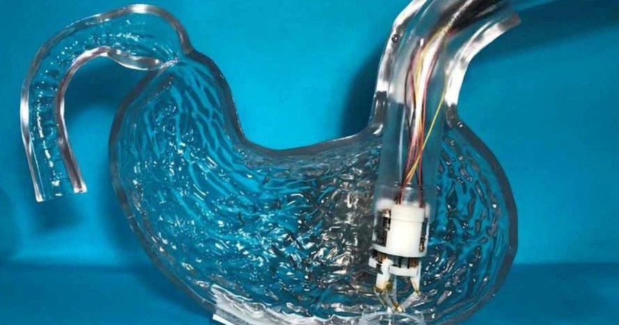 Phát triển máy in sinh học siêu nhỏ có thể chữa lành loét dạ dày