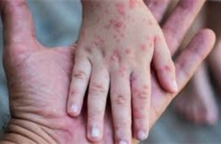 Dịch sởi bùng phát mạnh tại Mỹ, hàng trăm trẻ em phải cách ly