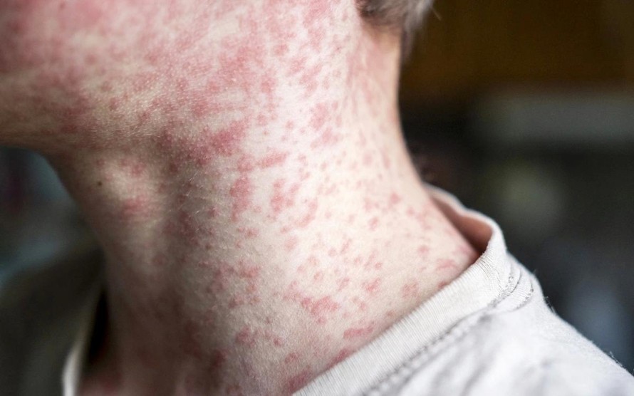 Nguy cơ bệnh sởi lan rộng tại châu Mỹ