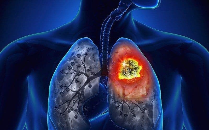 Điều trị miễn dịch buổi sáng giúp bệnh nhân ung thư phổi sống lâu hơn