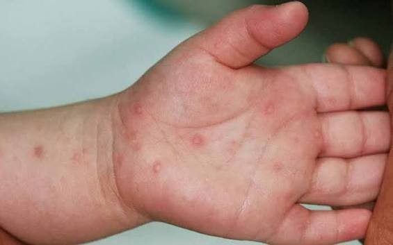 Bệnh tay chân miệng vào mùa, xuất hiện nhiều ca nặng phải thở máy​