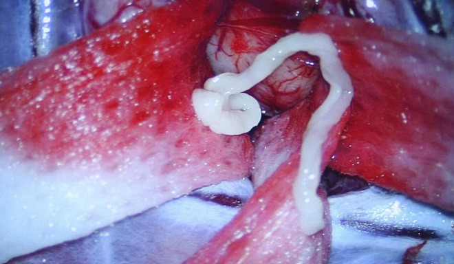 Ký sinh trùng trong não của bệnh nhân