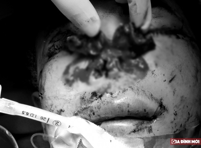 Hình ảnh tình trạng đa chấn thương của bệnh nhân bị tai nạn nổ bình ga