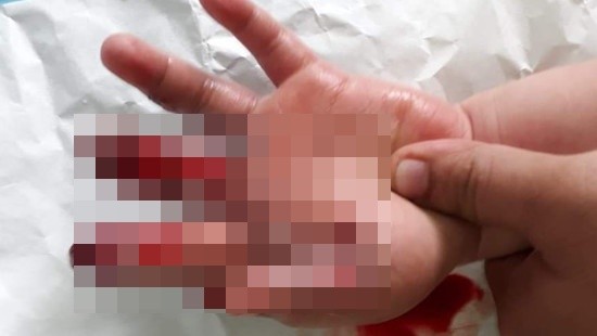 Bé trai bị dập nát bàn tay vì pháo nổ