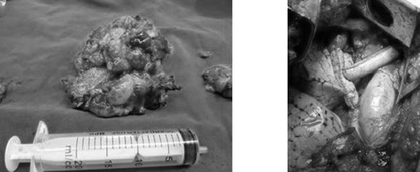 Khối u của bệnh nhân được bóc tách 