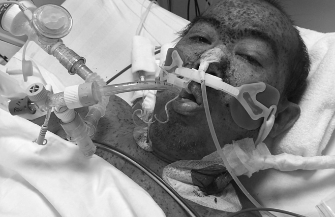 Khắp người bệnh nhân chằng chịt nốt hồng ban trong ngày đầu nhập viện. Ảnh: Minh Tâm.