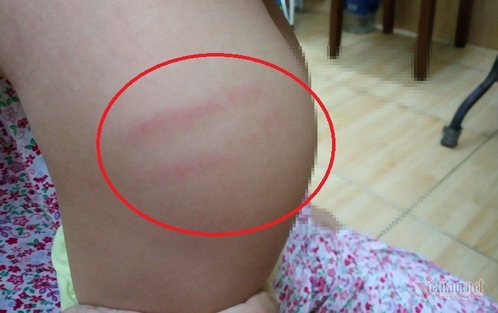 Hình ảnh 2 vết bầm tím phụ huynh chụp lại. - Ảnh: Vietnamnet