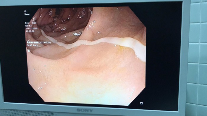 Hình ảnh nội soi trong đại tràng. - Ảnh: Vietnamnet