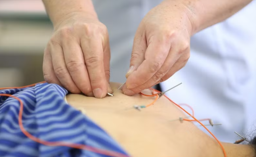 Các bệnh nhân được sử dụng phương pháp Điện châm tại Bệnh viện Y học cổ truyền tỉnh Lạng Sơn. 