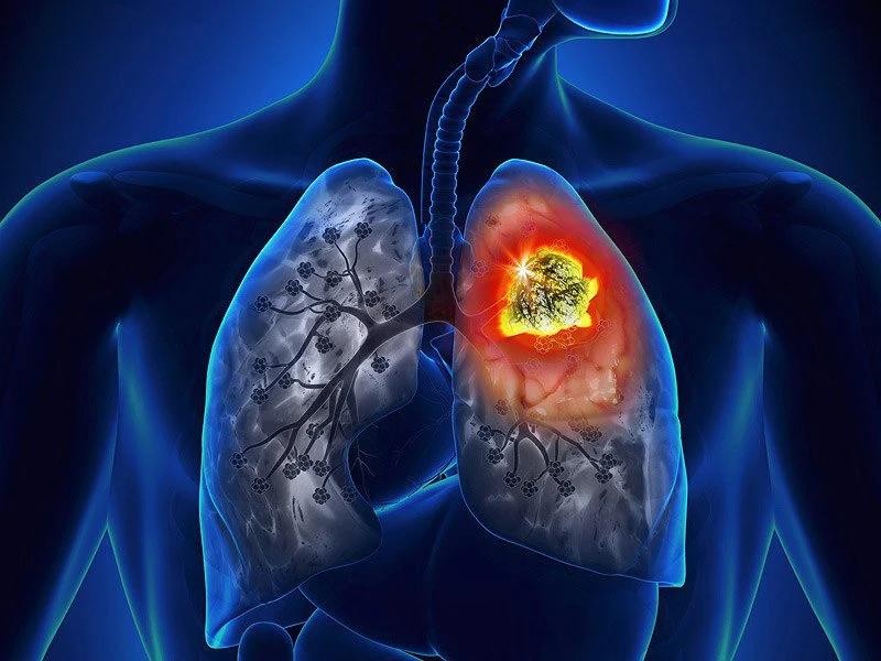 Mô hình AI dự đoán gene ung thư phổi với độ chính xác tới 90%