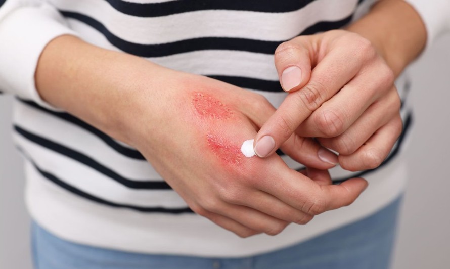 Phát triển da nhân tạo sinh học giúp điều trị bỏng nặng