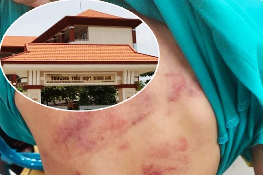 Vết thương của học sinh lớp 1 do bị bạn bạo hành và trường Tiểu học Bình An (ảnh nhỏ).