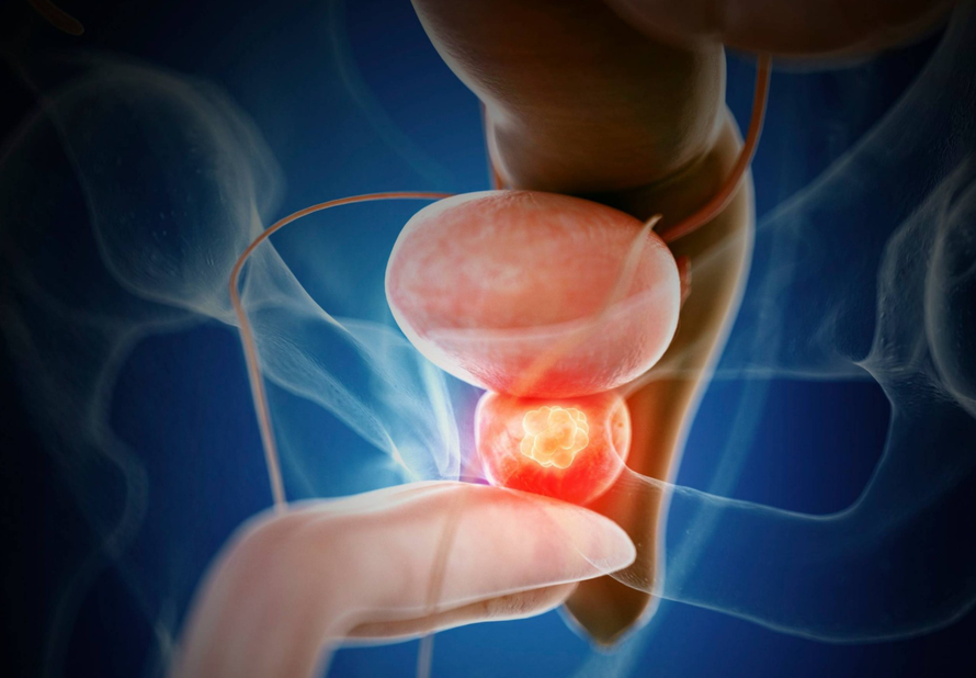 Khám phá mới hé lộ cơ chế hình thành ung thư tuyến tiền liệt