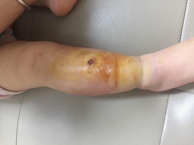 Tổn thương ở chân bé T. sưng nóng, đỏ kèm mụn mủ.