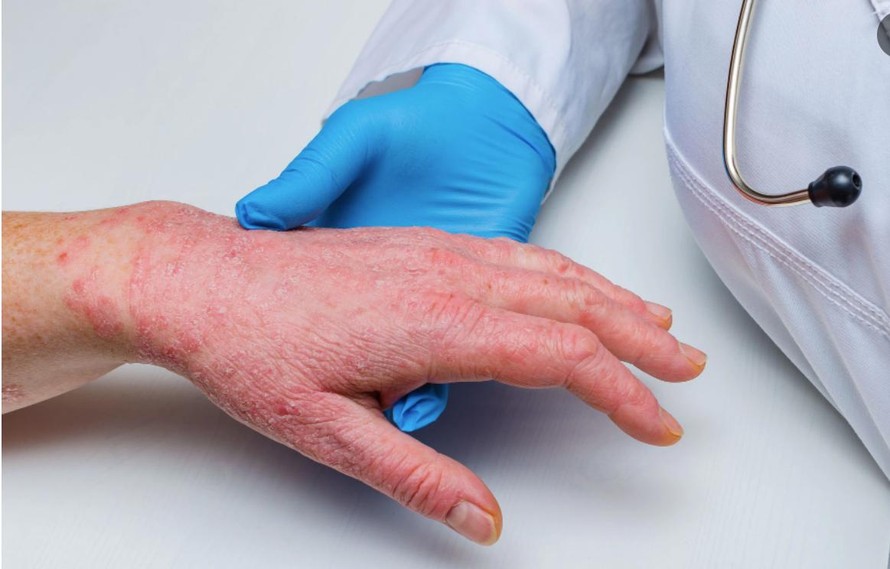 Bộ Y tế hướng dẫn các biện pháp phòng, chống tạm thời với bệnh đậu mùa khỉ