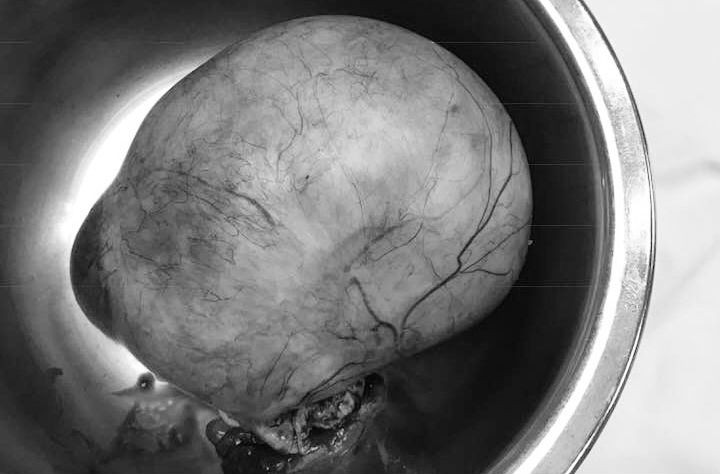 Khối u khủng khiến người phụ nữ nhập viện khẩn cấp - Ảnh: VietNamNet