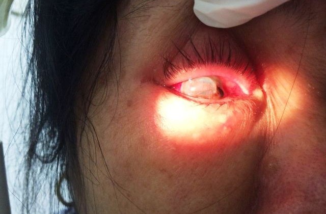 Mắt phải vỡ nhãn cầu của chị N - Ảnh: Sức khỏe và Đời sống