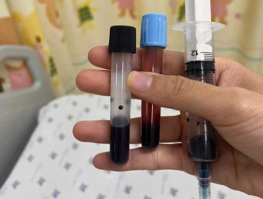 Mẫu máu xét nghiệm chuyển màu nâu đen của bé.