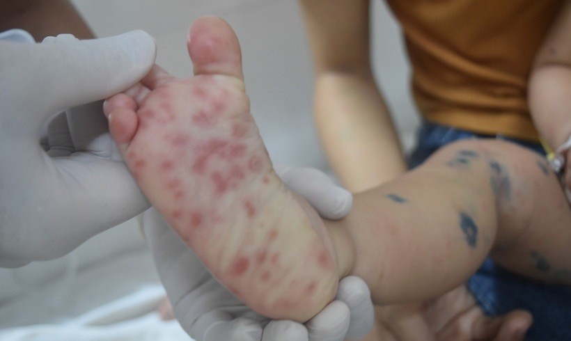 Các nốt phát ban của bệnh nhi bị tay chân miệng.