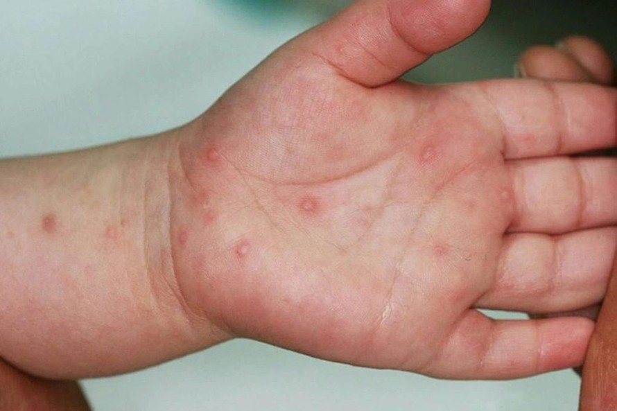 Số trẻ mắc bệnh tay chân miệng tăng gấp 3,5 lần so với cùng kỳ năm trước