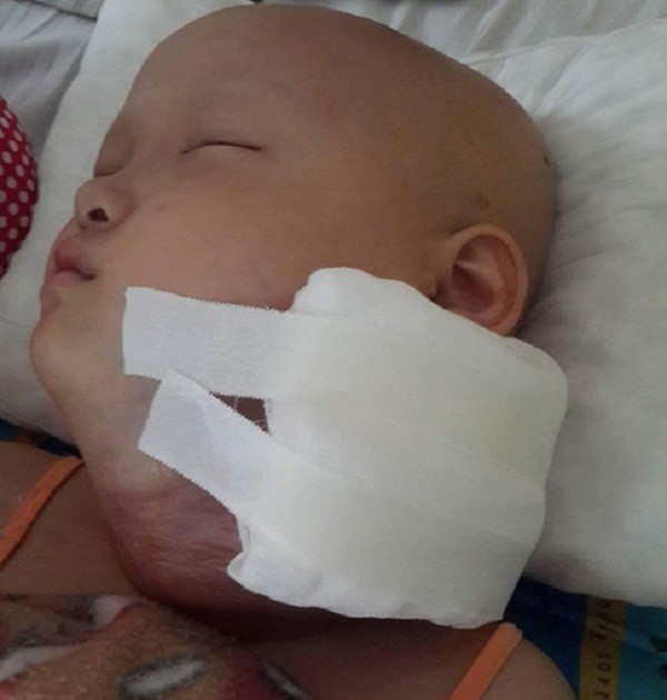 Bé gái xinh như thiên thần bị căn bệnh quái ác hủy hoại khuôn mặt